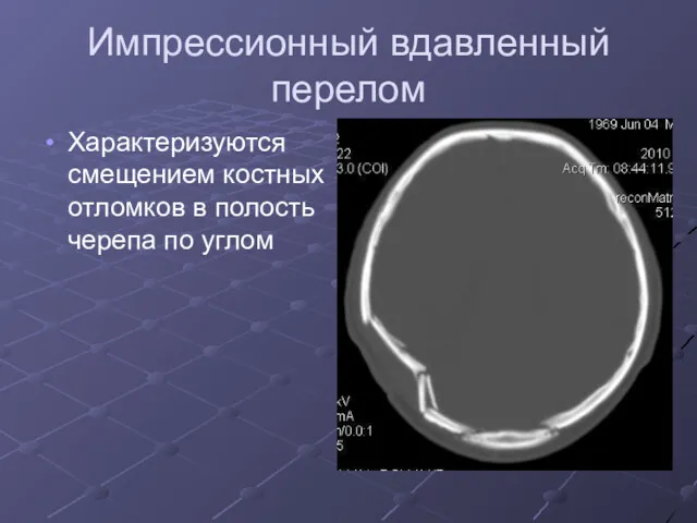 Импрессионный вдавленный перелом Характеризуются смещением костных отломков в полость черепа по углом