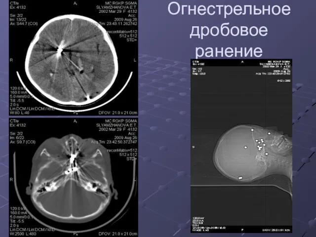 Огнестрельное дробовое ранение