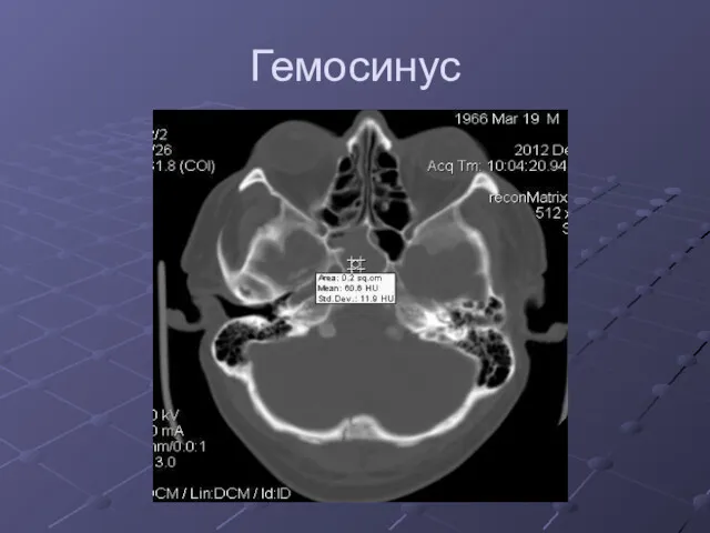 Гемосинус