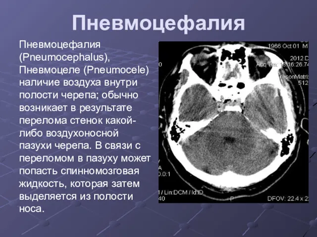 Пневмоцефалия Пневмоцефалия (Pneumocephalus), Пневмоцеле (Pneumocele)наличие воздуха внутри полости черепа; обычно