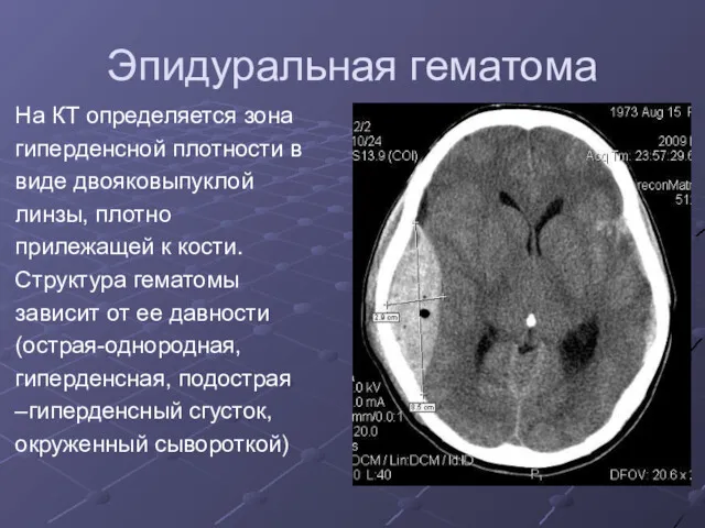 Эпидуральная гематома На КТ определяется зона гиперденсной плотности в виде