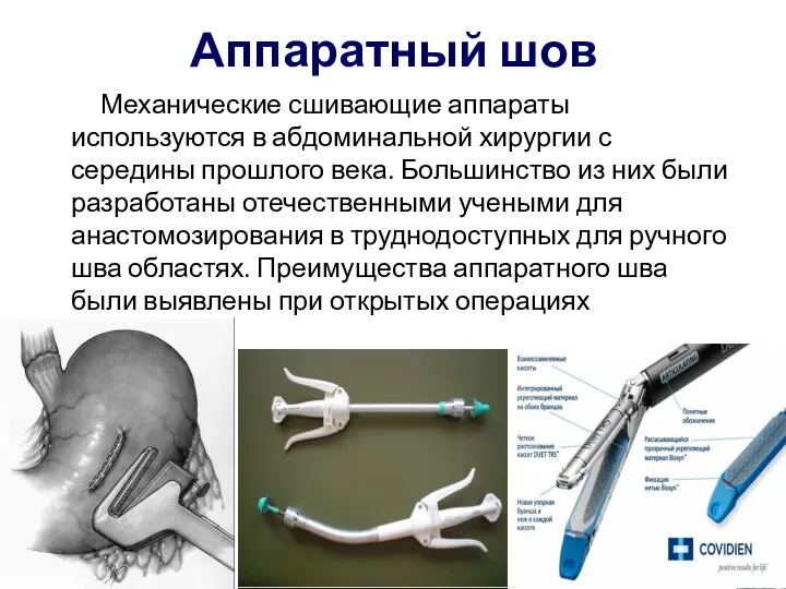 Аппаратный шов Механические сшивающие аппараты используются в абдоминальной хирургии с середины прошлого века.