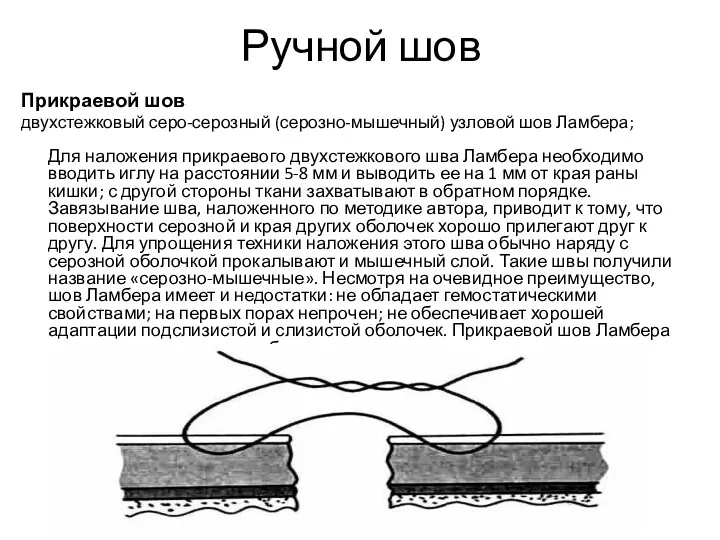Ручной шов Прикраевой шов двухстежковый серо-серозный (серозно-мышечный) узловой шов Ламбера;