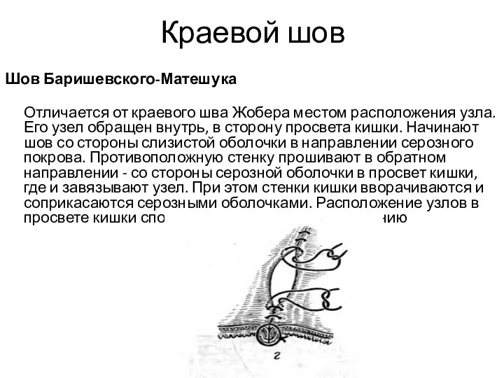 Краевой шов Шов Баришевского-Матешука Отличается от краевого шва Жобера местом расположения узла. Его