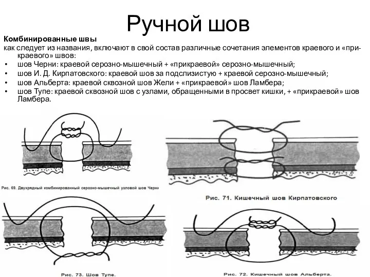 Ручной шов Комбинированные швы как следует из названия, включают в свой состав различные