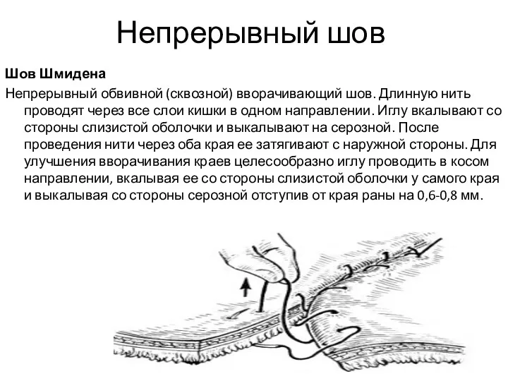 Непрерывный шов Шов Шмидена Непрерывный обвивной (сквозной) вворачивающий шов. Длинную