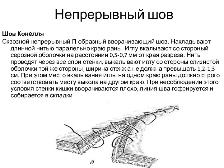 Непрерывный шов Шов Конелля Сквозной непрерывный П-образный вворачивающий шов. Накладывают