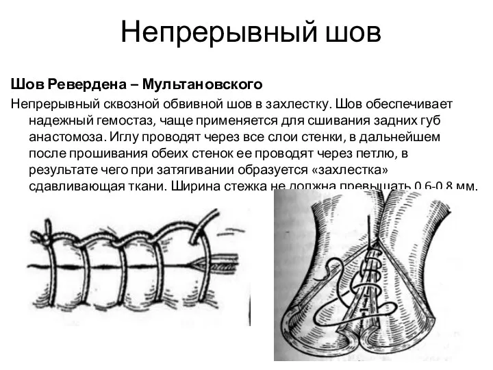 Непрерывный шов Шов Ревердена – Мультановского Непрерывный сквозной обвивной шов