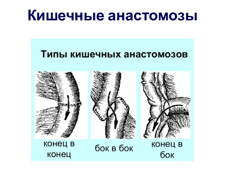 Кишечные анастомозы