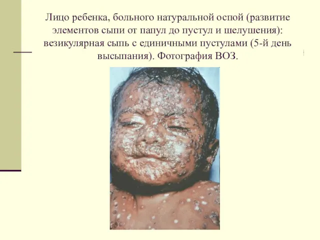 Лицо ребенка, больного натуральной оспой (развитие элементов сыпи от папул до пустул и