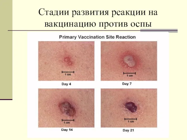Стадии развития реакции на вакцинацию против оспы
