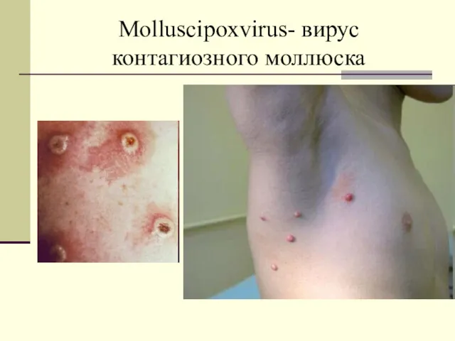 Molluscipoxvirus- вирус контагиозного моллюска
