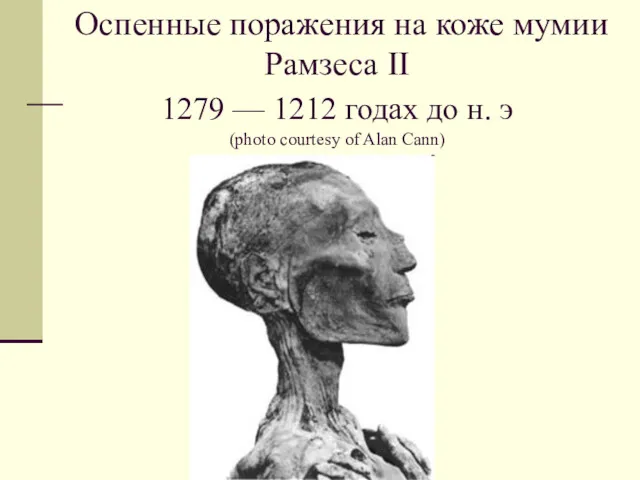 Оспенные поражения на коже мумии Рамзеса II 1279 — 1212 годах до н.
