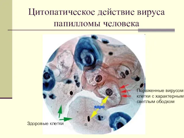 Цитопатическое действие вируса папилломы человека Здоровые клетки Пораженные вирусом клетки с характерным светлым ободком