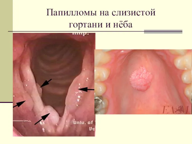 Папилломы на слизистой гортани и нёба