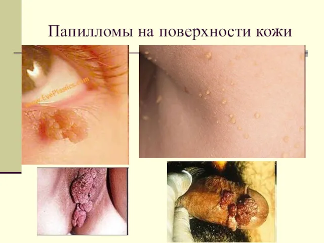 Папилломы на поверхности кожи