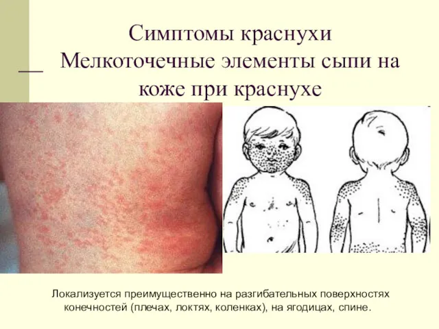 Симптомы краснухи Мелкоточечные элементы сыпи на коже при краснухе Локализуется преимущественно на разгибательных