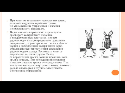 При мнимом вправление ущемленных грыж, исчезают наружные признаки грыжи, но