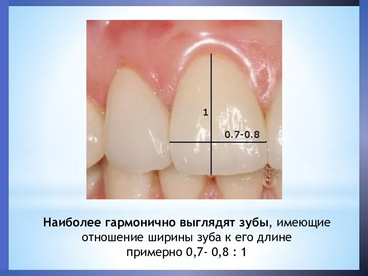 Наиболее гармонично выглядят зубы, имеющие отношение ширины зуба к его длине примерно 0,7- 0,8 : 1