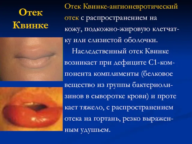 Отек Квинке Отек Квинке-ангионевротический отек с распространением на кожу, подкожно-жировую