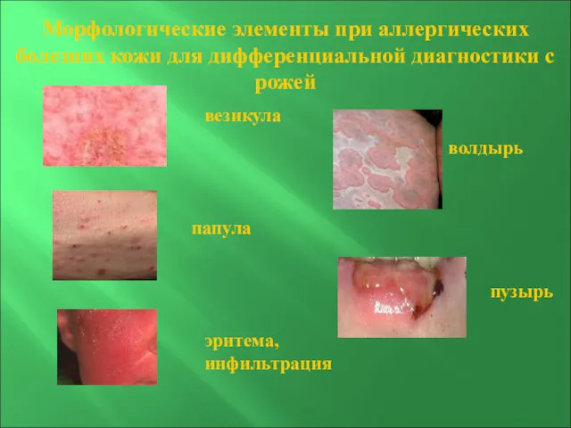 везикула папула эритема, инфильтрация волдырь пузырь Морфологические элементы при аллергических