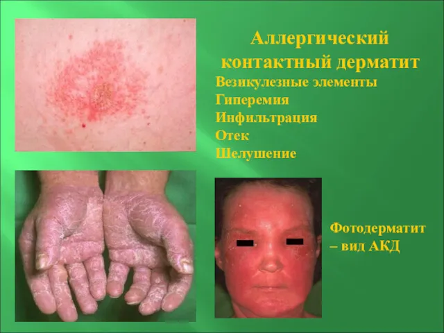 Аллергический контактный дерматит Везикулезные элементы Гиперемия Инфильтрация Отек Шелушение Фотодерматит – вид АКД