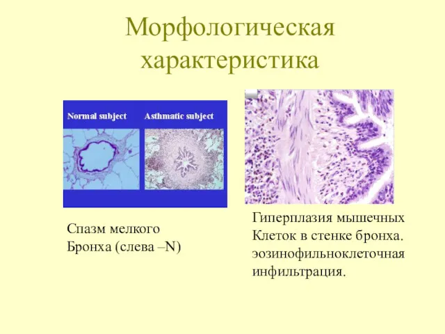 Морфологическая характеристика Спазм мелкого Бронха (слева –N) Гиперплазия мышечных Клеток в стенке бронха. эозинофильноклеточная инфильтрация.