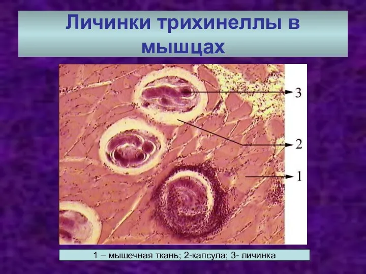 Личинки трихинеллы в мышцах 1 – мышечная ткань; 2-капсула; 3- личинка