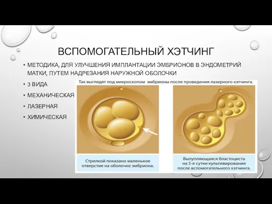 ВСПОМОГАТЕЛЬНЫЙ ХЭТЧИНГ МЕТОДИКА, ДЛЯ УЛУЧШЕНИЯ ИМПЛАНТАЦИИ ЭМБРИОНОВ В ЭНДОМЕТРИЙ МАТКИ, ПУТЕМ НАДРЕЗАНИЯ НАРУЖНОЙ