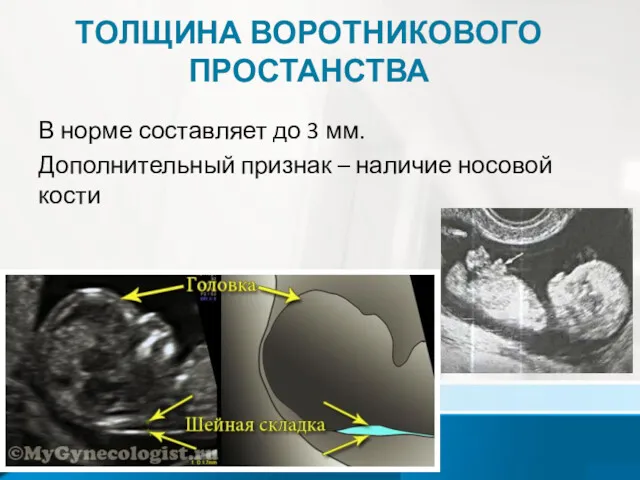 ТОЛЩИНА ВОРОТНИКОВОГО ПРОСТАНСТВА В норме составляет до 3 мм. Дополнительный признак – наличие носовой кости