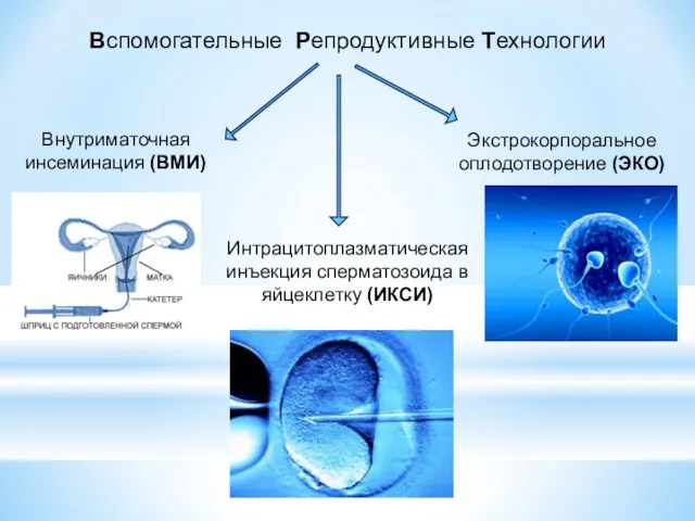 Вспомогательные Репродуктивные Технологии Внутриматочная инсеминация (ВМИ) Экстрокорпоральное оплодотворение (ЭКО) Интрацитоплазматическая инъекция сперматозоида в яйцеклетку (ИКСИ)