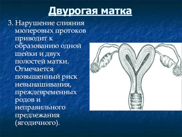 Двурогая матка 3. Нарушение слияния мюлеровых протоков приводит к образованию