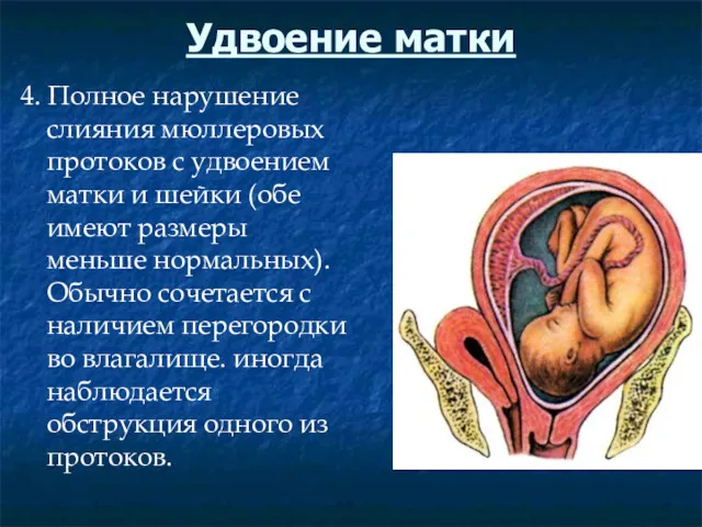 Удвоение матки 4. Полное нарушение слияния мюллеровых протоков с удвоением