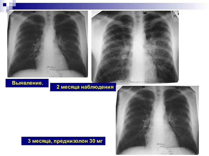 Выявление. 2 месяца наблюдения 3 месяца, преднизолон 30 мг