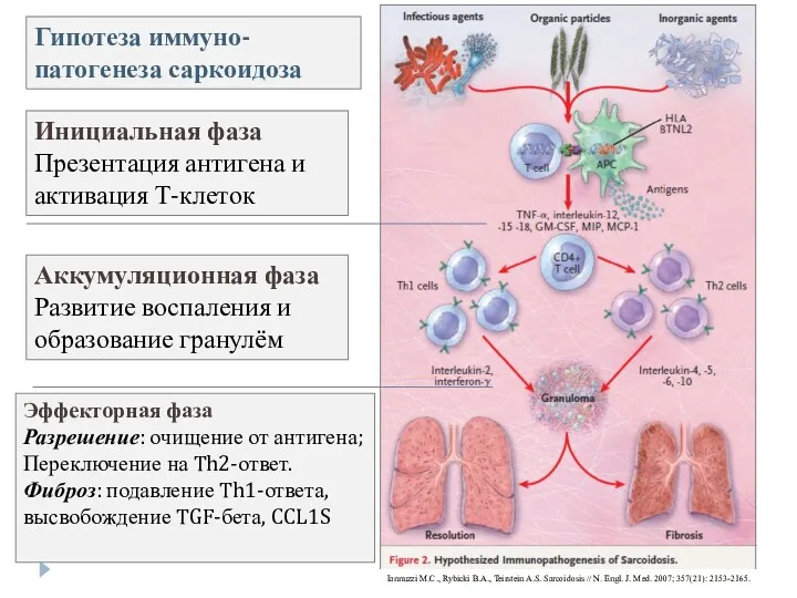 Гипотеза иммуно-патогенеза саркоидоза Iannuzzi M.C., Rybicki B.A., Teirstein A.S. Sarcoidosis