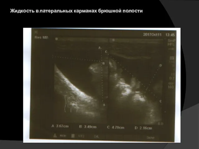 Жидкость в латеральных карманах брюшной полости