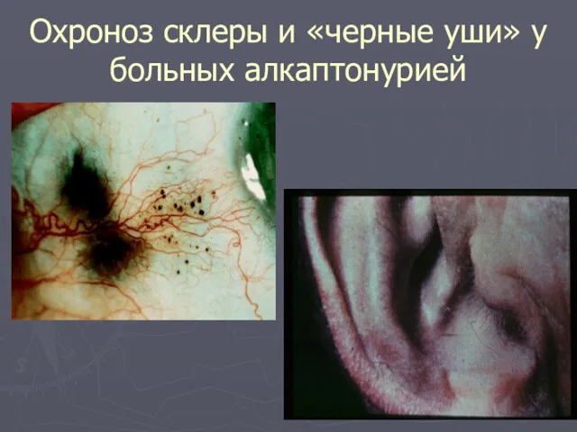 Охроноз склеры и «черные уши» у больных алкаптонурией