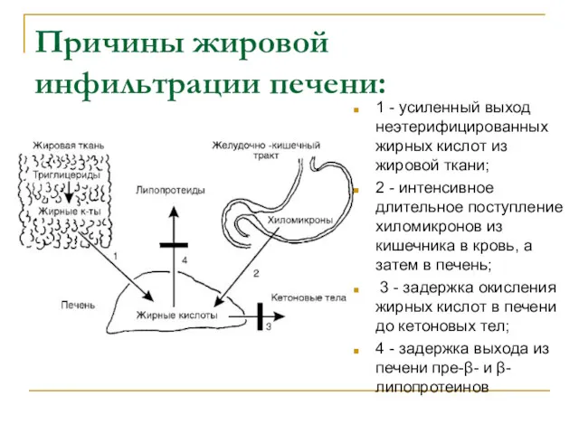 Причины жировой инфильтрации печени: 1 - усиленный выход неэтерифицированных жирных