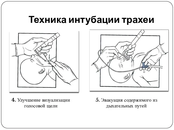 Техника интубации трахеи 4. Улучшение визуализации голосовой щели 5. Эвакуация содержимого из дыхательных путей