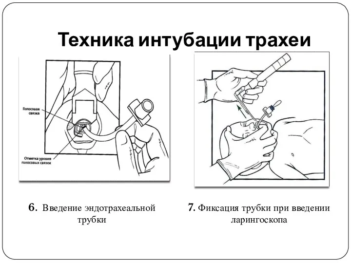 Техника интубации трахеи 6. Введение эндотрахеальной трубки 7. Фиксация трубки при введении ларингоскопа