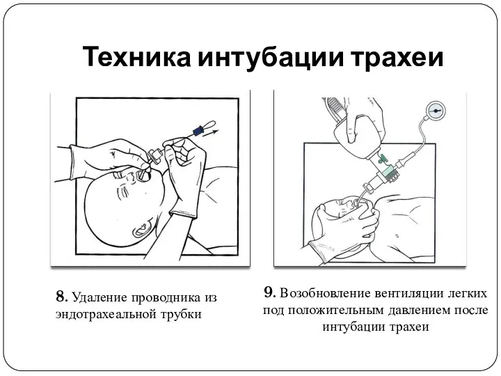 Техника интубации трахеи 8. Удаление проводника из эндотрахеальной трубки 9.