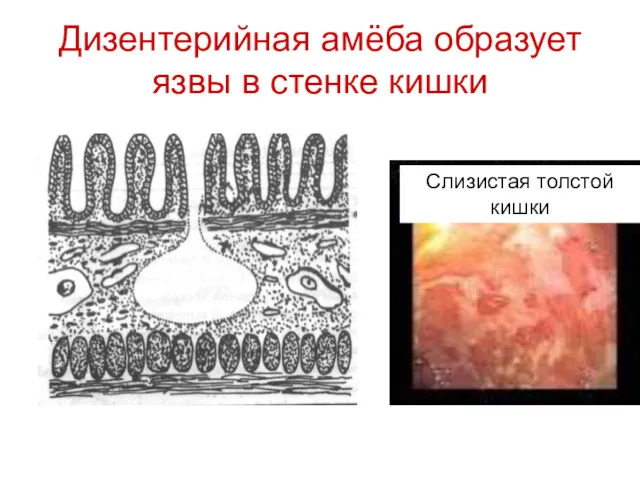 Дизентерийная амёба образует язвы в стенке кишки Слизистая толстой кишки