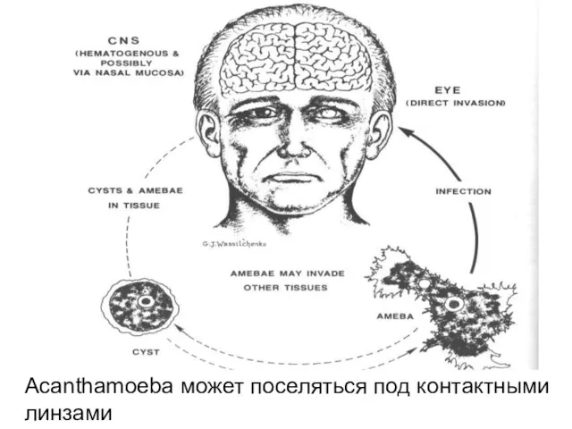 Acanthamoeba может поселяться под контактными линзами