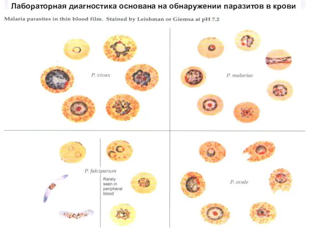 Лабораторная диагностика основана на обнаружении паразитов в крови