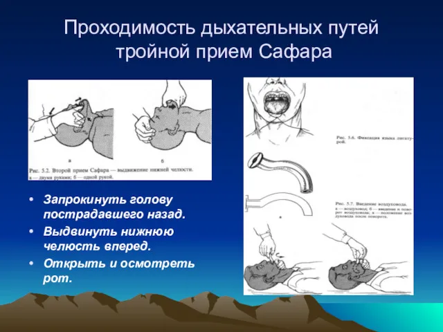 Проходимость дыхательных путей тройной прием Сафара Запрокинуть голову пострадавшего назад.