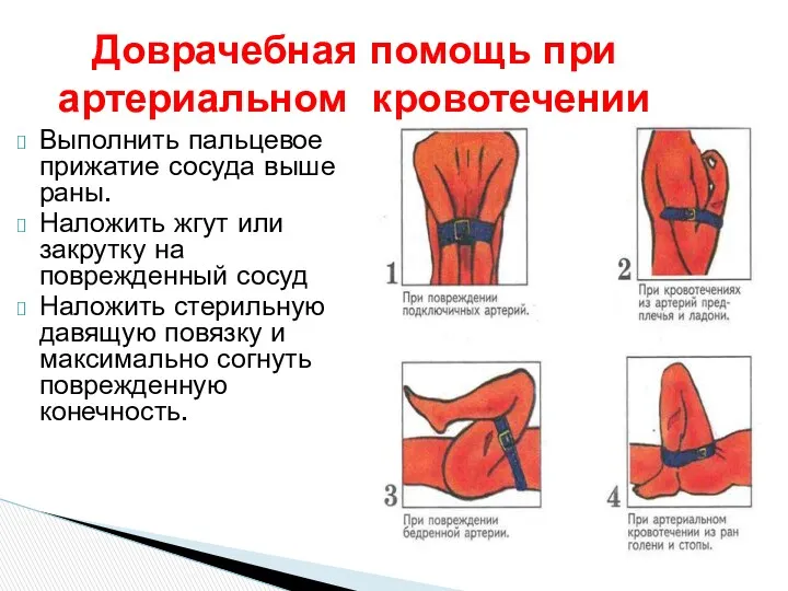 Доврачебная помощь при артериальном кровотечении Выполнить пальцевое прижатие сосуда выше