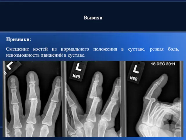 Вывихи Признаки: Смещение костей из нормального положения в суставе, резкая боль, невозможность движений в суставе.