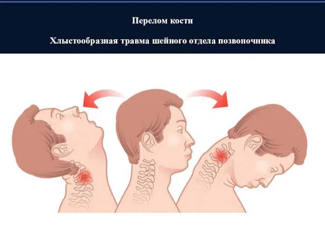 Перелом кости Хлыстообразная травма шейного отдела позвоночника