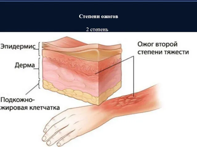 Степени ожогов 2 степень