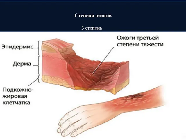 Степени ожогов 3 степень